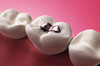 dental_filling.jpg